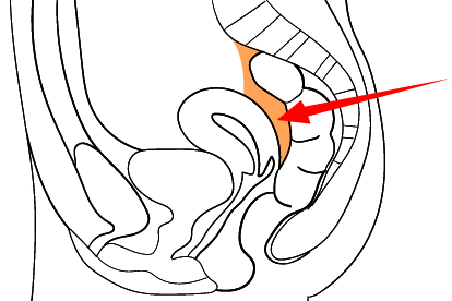 直肠子宫陷凹位置