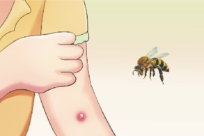 蜜蜂蛰了化脓照片
