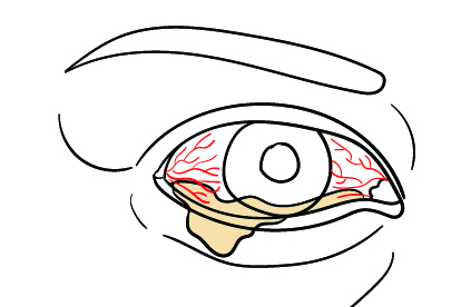 眼睛真菌感染图片