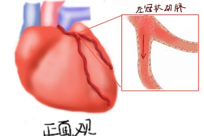 左心室壁冠脉垂直供血图片