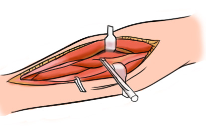 筋膜切开术图