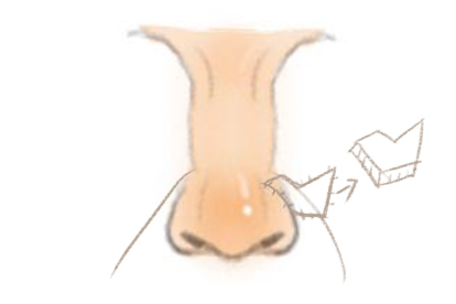 鼻唇沟皮瓣手术图