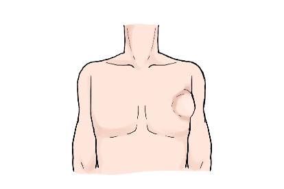 男胸口脂肪瘤图