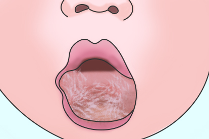 舌头淋巴管畸形图