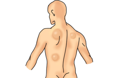 背部淋巴瘤图片