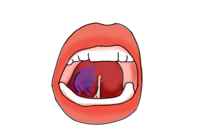 淋巴瘤舌头图片