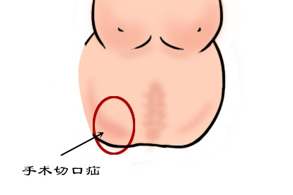 腹部手术切口疝图