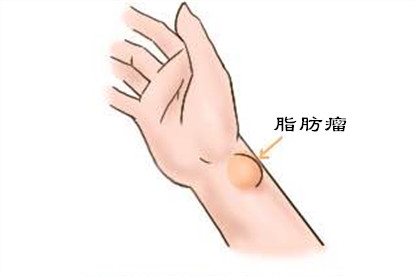 手腕脂肪瘤图片