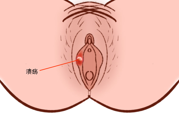 外阴阴唇溃疡图片