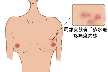乳房带状疱疹图片