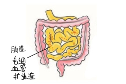 肠道毛细血管扩张症图片