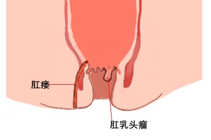 肛瘘乳头状瘤图片