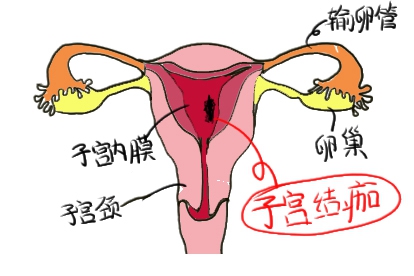 子宫结痂图片