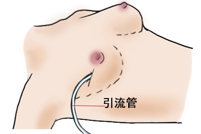 乳腺脓肿引流管图片