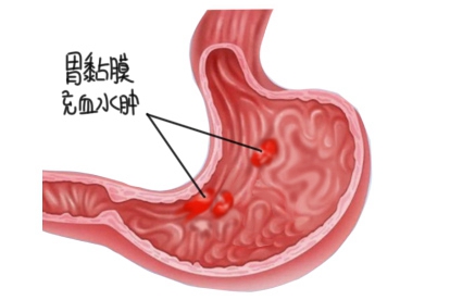 胃黏膜充血水肿图片