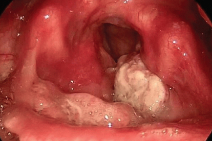 喉癌晚期图片