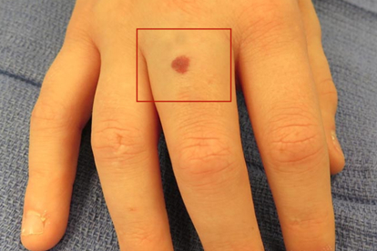 成人手指血管瘤图片