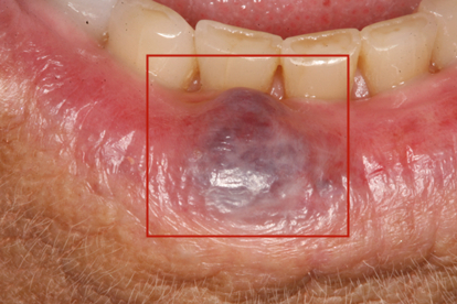 嘴唇血管瘤图片
