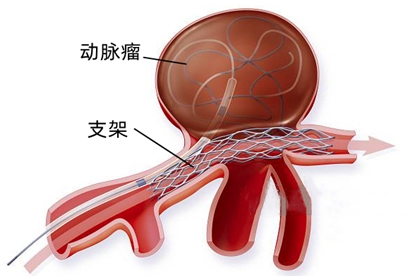 动脉瘤支架图片