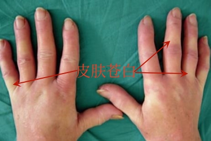 手指脉管炎早期图片