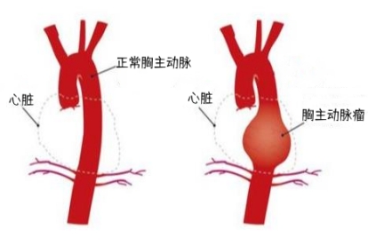胸主动脉瘤图片