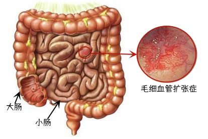 小肠毛细血管扩张症图片