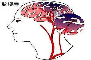 这三个症状，提示脑血管已悄悄出现病变，建议早做脑CT！