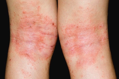 湿疹导致皮肤皱褶处皮疹图片