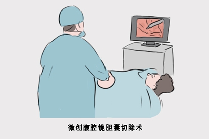 微创腹腔镜胆囊切除术的图片