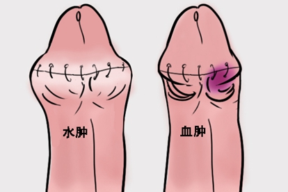 割包皮水腫與血腫的圖片