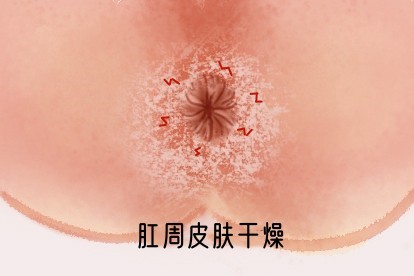 肛周皮肤干燥导致肛周皲裂图片