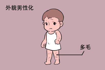 女婴儿皮质增生症外贸男性化图