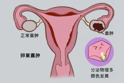 卵巢囊肿的图片