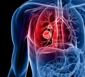 肺癌新靶向治疗药达可替尼片在哪里买,多少钱