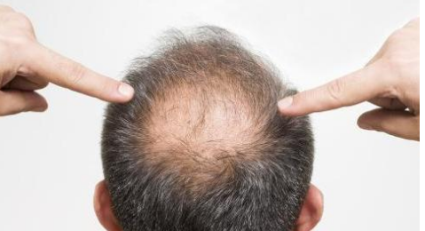 脂溢性脱发的症状有哪些？得了脂溢性脱发，米诺地尔可以治疗吗？