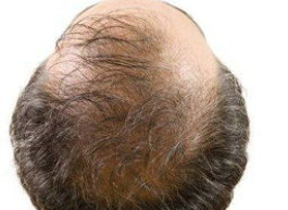 雄性脱发和脂溢性脱发的区别