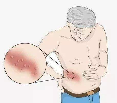 带状疱疹后期痒正常吗