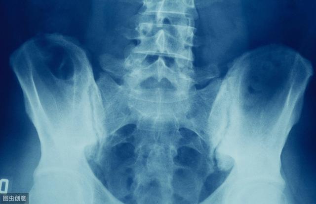 强直性脊柱炎：狡猾的脊柱“杀手”，用1个部位进行早期判断