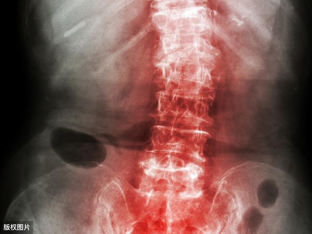 强直性脊柱炎：不要和这9种疾病搞混了，日常护理7方面需注意