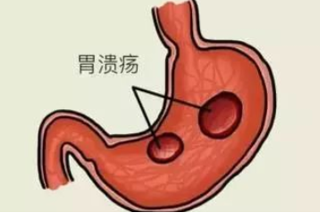 什么是胃溃疡？
